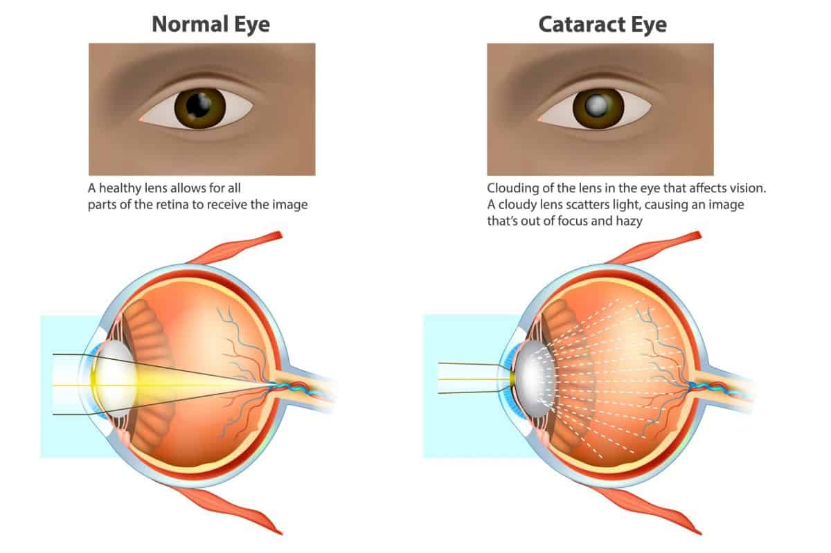 Cataract surgery in NYC