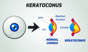Keratoconus treatment Astoria 