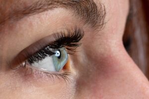 Woman's eye affected by keratoconus can be treated in NYC.