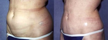 Liposuction Patient Gallery for the Bay Area 