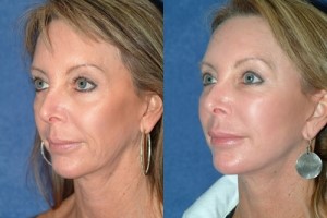 Facelift Patient Gallery for the Bay Area
