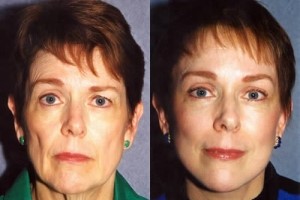 Brow Lift Patient Gallery for the Bay Area