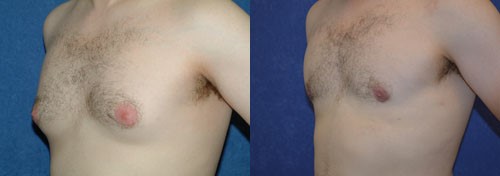 Male Breast Reduction Patient Photos