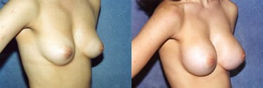 Breast Implant Patient Gallery