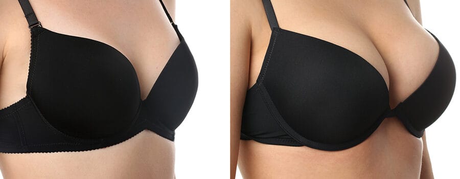 Breast Augmentation Surgery Before and After