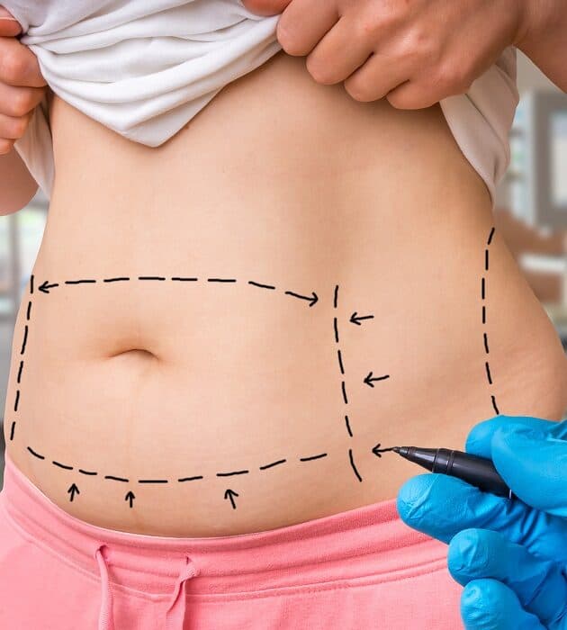 Tummy Tuck Rockford, IL - Abdominoplasty - Dr. Rodriguez