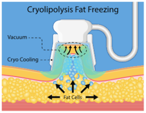 Kentucky Skin Cancer Center – Coolsculpting – Nonsurgical Fat Reduction