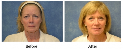 Louisville facelift patient before and after face lift surgery with Dr. Maguire