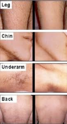 Louisville Laser Hair Removal by Dr Maguire