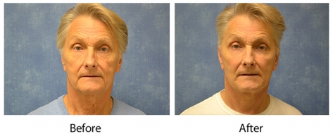 Male Louisville Facelift before & after photos – Dr. Sean Maguire