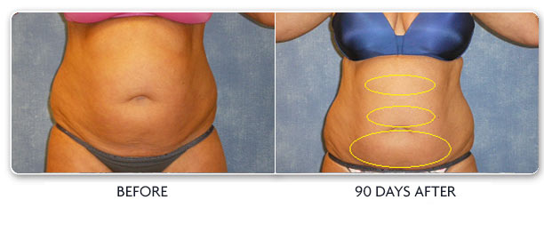 Louisville Coolsculpting Elite Procedures Before and After Photos