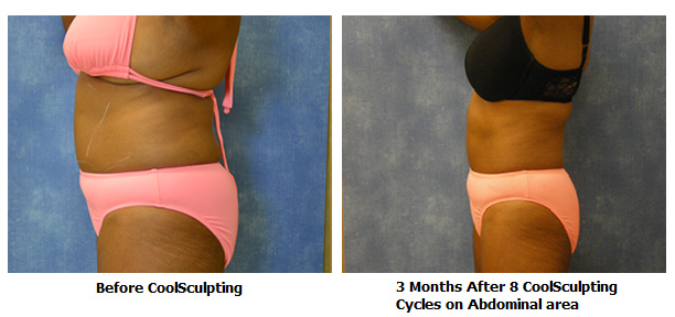 Louisville Coolsculpting Elite Procedures Before and After Photos