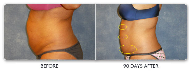 Louisville Coolsculpting Elite Procedures Before and After Photos