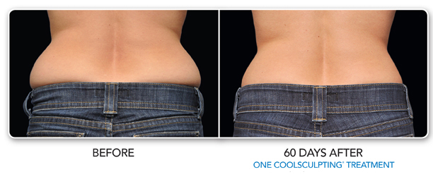 Louisville Coolsculpting Elite Procedures Before and After Photos