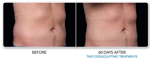 Louisville Coolsculpting Elite Procedures Before and After Photos