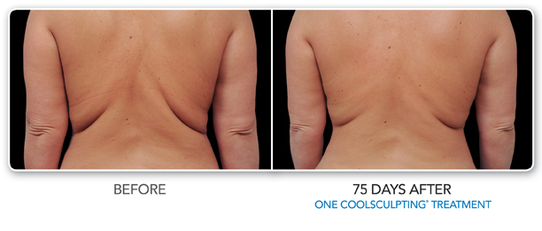 Louisville Coolsculpting Elite Procedures Before and After Photos