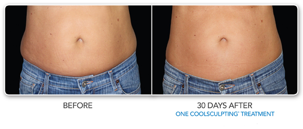 Louisville Coolsculpting Elite Procedures Before and After Photos