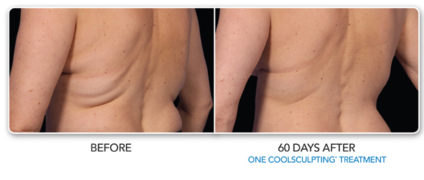 Louisville Coolsculpting Elite Procedures Before and After Photos