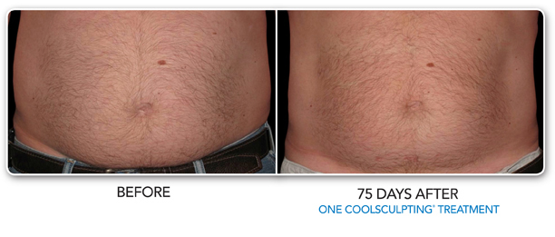 Male Louisville Coolsculpting Elite before & after treatment