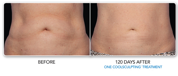 CoolSculpting Before & After Photo Gallery