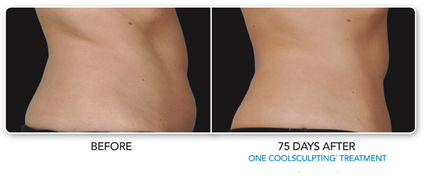 Louisville Coolsculpting Elite Procedures Before and After Photos