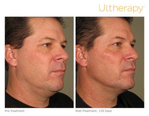 Ultherapy non-surgical facelift Louisville, KY