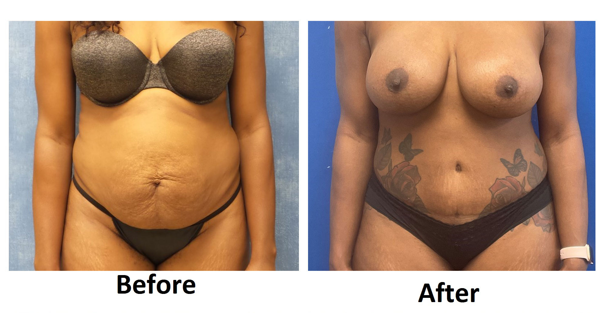 Tummy Tuck Before & After Photos Louisville, KY - Abdominoplasty