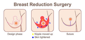 Breast reduction surgeon in Louisville 