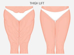 Thigh lift plastic surgeon in Louisville 