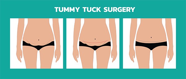 Tummy Tuck Abdominoplasty Scars