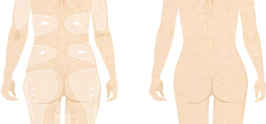 Body Contouring - Thigh Lift, Plastic Surgeon - Surrey