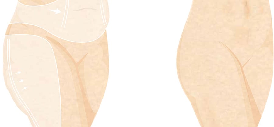 Lower Body Liposuction in Surrey, BC