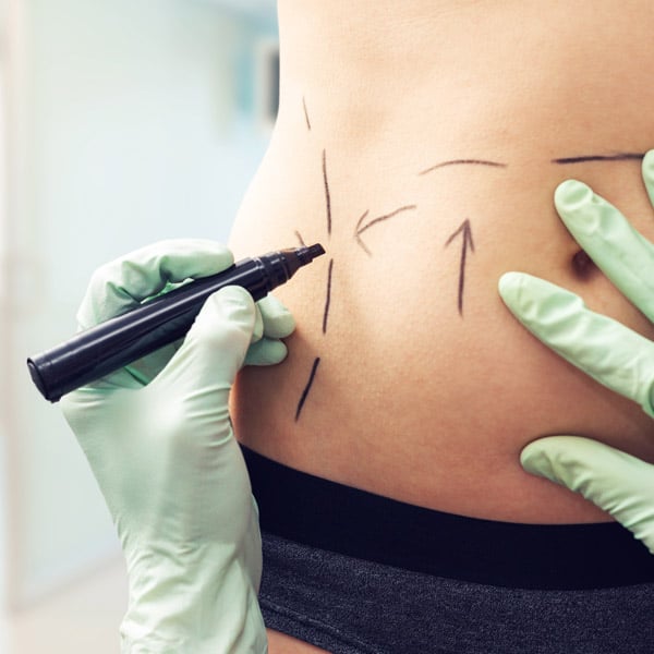 Abdominoplasty in Surrey BC - Tummy Tuck Near Langley BC