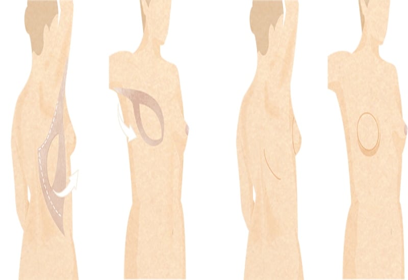 Latissimus Reconstruction in Surrey