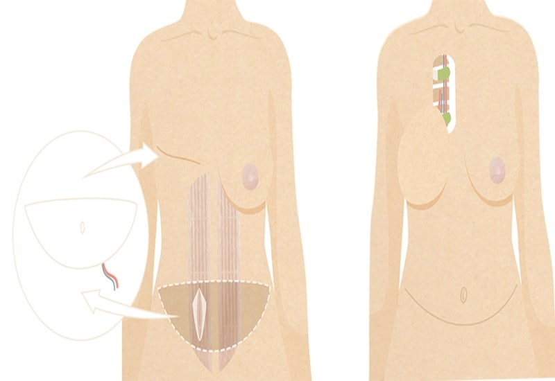 How a “New” Belly Button is Created During DIEP Flap Breast