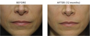 Portland Dermal Filler Radiesse®