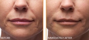 Portland facial injectables patient
