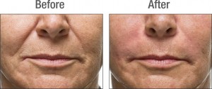 radiesse-before-after-02