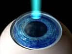 LASIK surgery Phoenix, AZ
