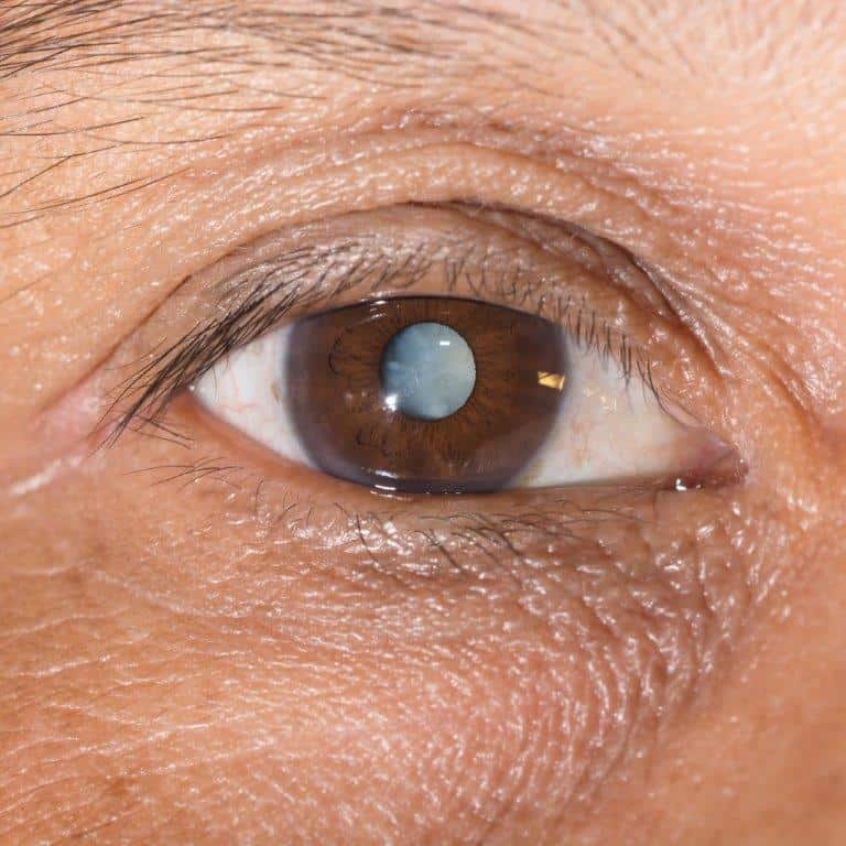 Can You Get A Cataract After Cataract Surgery at Jacob Hobbs blog