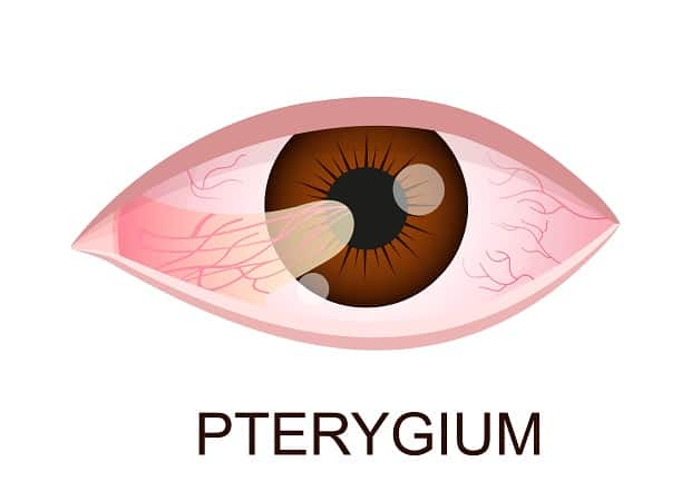 pterygium eye disease