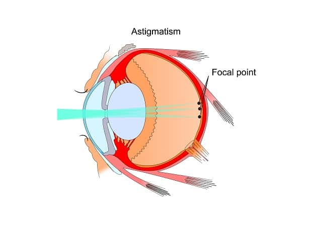 Astigmatism Treatment for St. Petersburg, FL