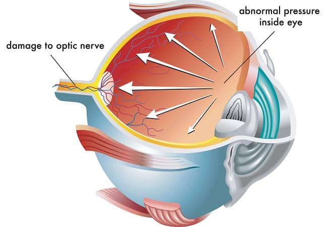 Glaucoma Treatment in Clearwater and St. Petersburg, FL