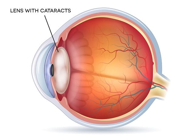 Lens with Cataract Illustration
