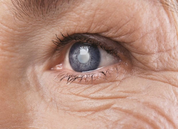 Symptoms of Cataracts