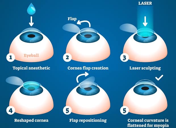 LASIK Procedure Details