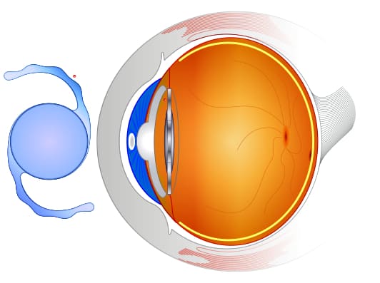 ICL for Eye Care for St. Petersburg & Clearwater, FL