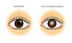 Cataract Surgery Largo FL