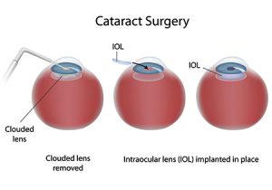Cataract Surgery Largo