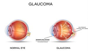 Glaucoma Largo